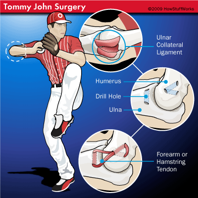 Cardinals' Lance Lynn has Tommy John elbow surgery